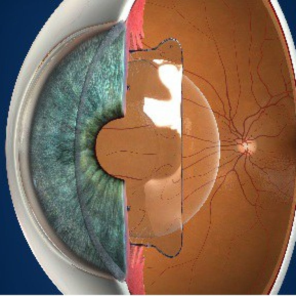 EVO Visian ICL IntraOcular Lenses Perth Laser Vision