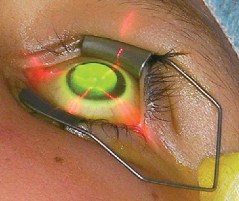 Corneal Cross Linking For Keratoconus Perth Laser Vision